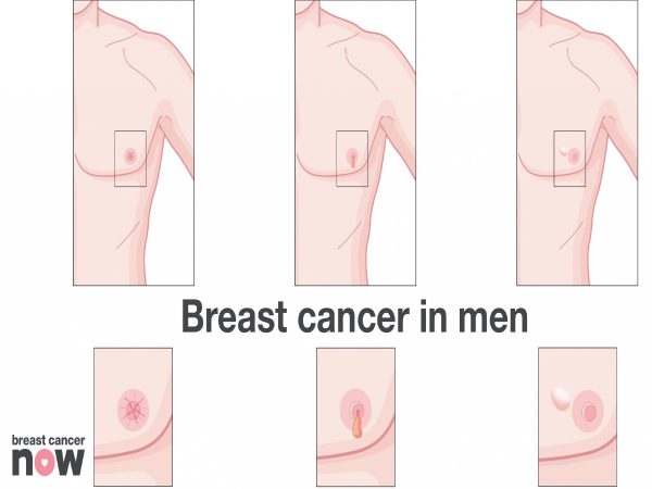 Breast Cancer In Men Breastcancerawarenessmonth River Online